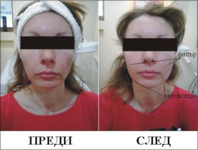 Мезоконци - Дермато-козметичен център Арт-Медика