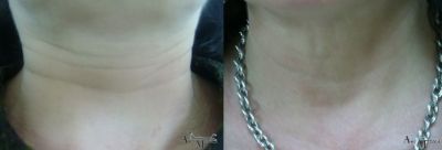 Мезотерапия - Дермато-козметичен център Арт-Медика