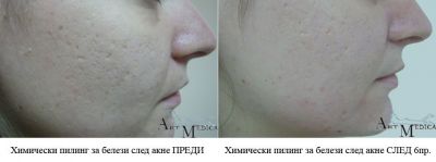 Химически пилинг преди и след - Дермато-козметичен център Арт-Медика